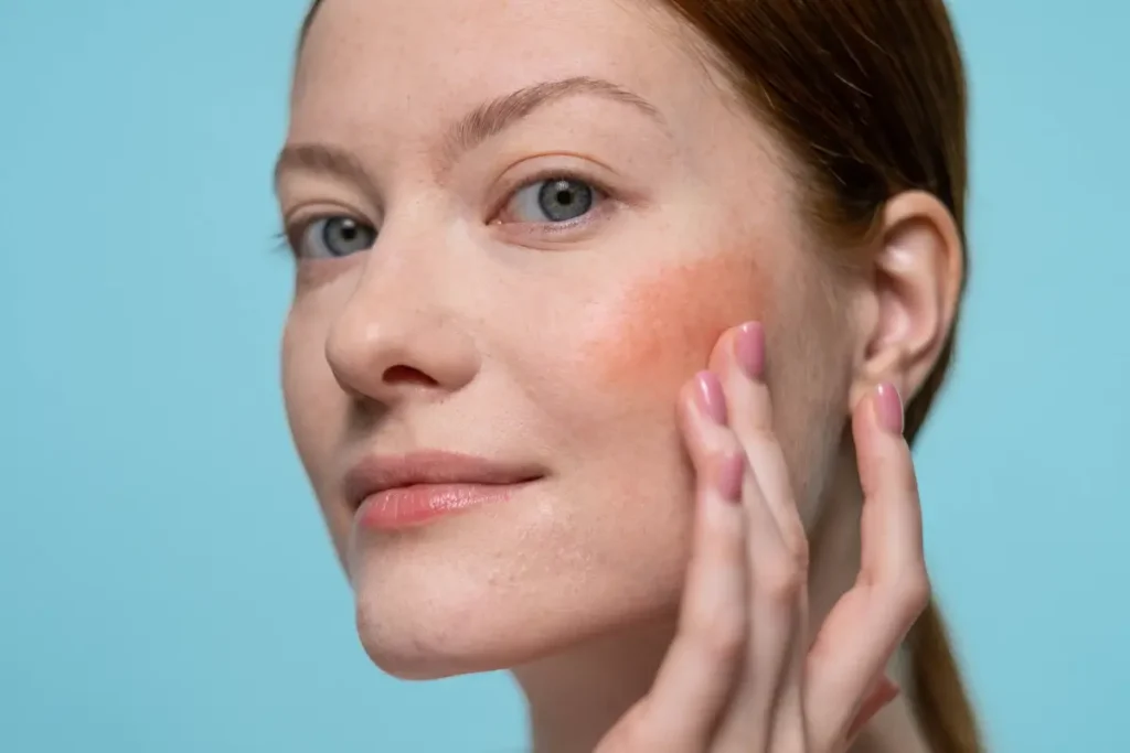 Does Korean Skincare Really Help Rosacea? - beautiful with mind